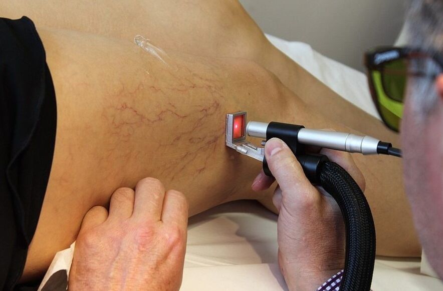 Laser-erradiazioa