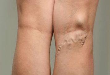 Barizeen diagnostikoa haurdun dauden emakumeengan