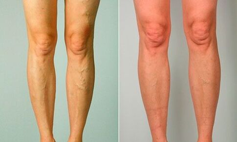 barizeak tratatzeko aurretik eta ondoren