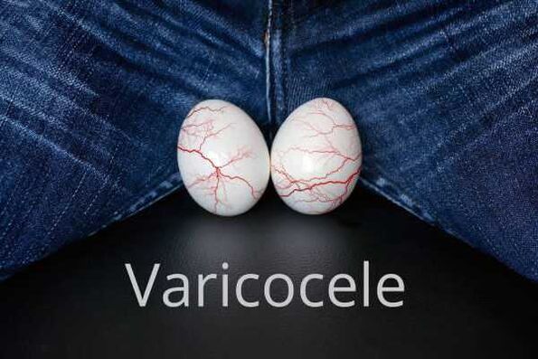 Varicocele - kable espermatikoaren zainen dilatazioa